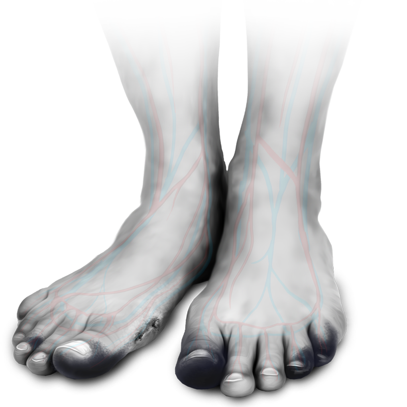 Two feet showing arteries in patient with PAD