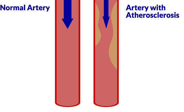 Normal Artery vs. Artery with Atherosclerosis Causing PAD